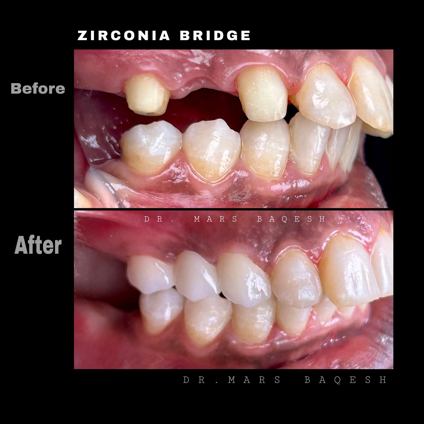Zirconia Bridge